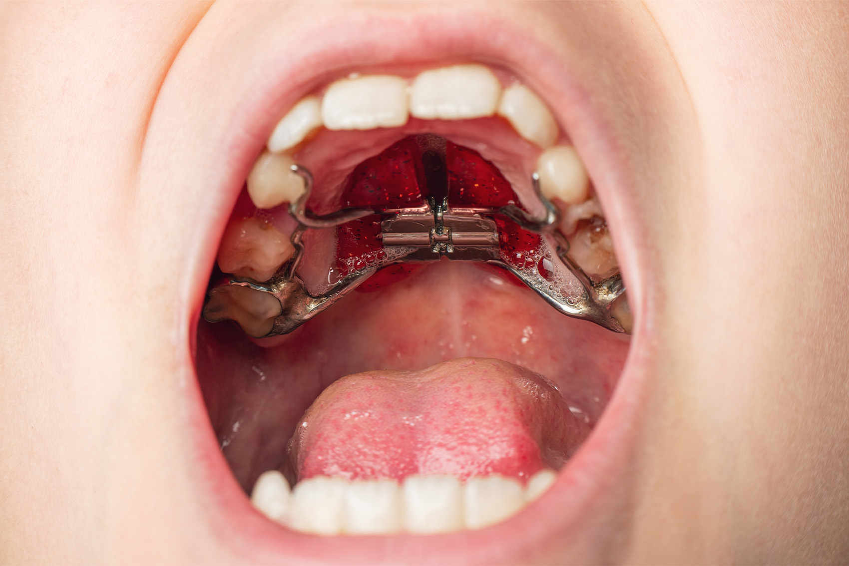 Child with open mouth wearing a Rapid Palatal Expander (RPE).